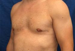 After Results for Gynecomastia