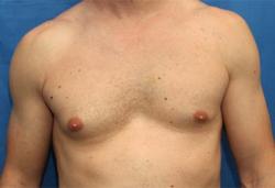 Before Results for Gynecomastia