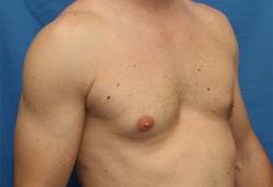 Before Results for Gynecomastia