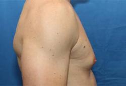 Before Results for Gynecomastia