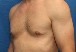 Before Results for Gynecomastia