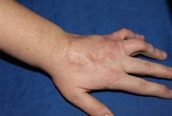 After Results for Wound Care, Hand Surgery