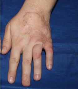 After Results for Wound Care, Hand Surgery