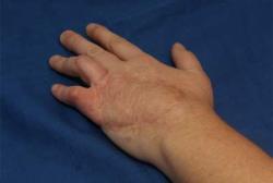 After Results for Hand Surgery