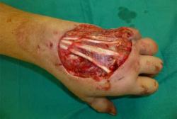 Before Results for Wound Care, Hand Surgery