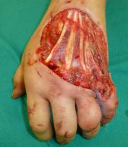 Before Results for Hand Surgery