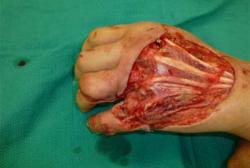 Before Results for Hand Surgery