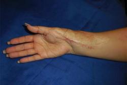 After Results for Wound Care, Hand Surgery