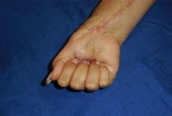 After Results for Wound Care, Hand Surgery