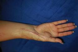 After Results for Hand Surgery
