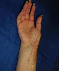 After Results for Hand Surgery