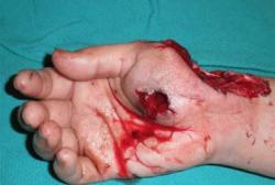 Before Results for Wound Care, Hand Surgery