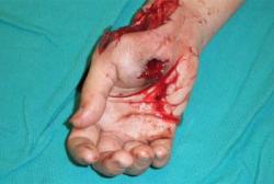 Before Results for Wound Care, Hand Surgery