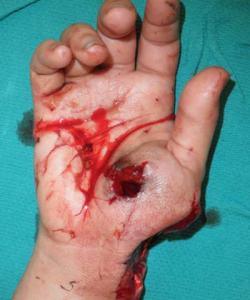 Before Results for Hand Surgery