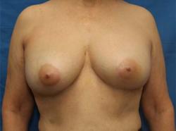 After Results for Breast Augmentation