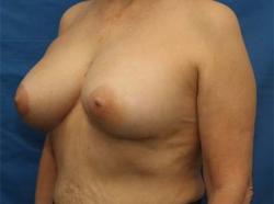 After Results for Breast Augmentation