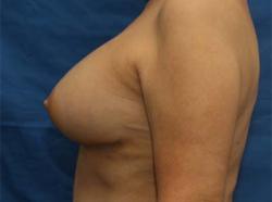 After Results for Breast Augmentation