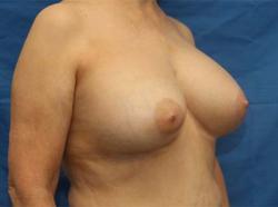 After Results for Breast Augmentation