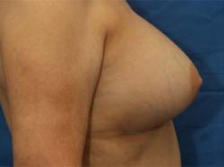 After Results for Breast Augmentation