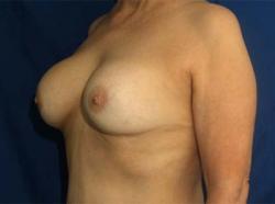 Before Results for Breast Augmentation, Implant Exchange and Removal
