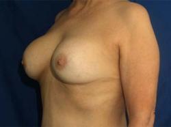 Before Results for Breast Augmentation, Implant Exchange and Removal 	