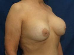 Before Results for Breast Augmentation