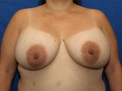 After Results for Breast Augmentation