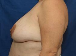 Before Results for Breast Augmentation