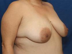 Before Results for Breast Augmentation