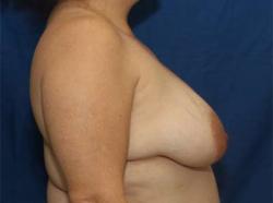 Before Results for Breast Augmentation