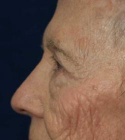 After Results for Blepharoplasty