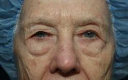 Before Results for Blepharoplasty