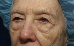 Before Results for Blepharoplasty