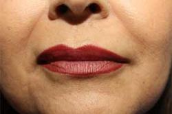 After Results for Tissue Fillers, Lip Augmentation