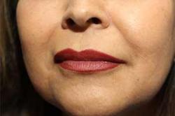 After Results for Lip Augmentation