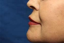 After Results for Lip Augmentation