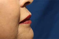 After Results for Lip Augmentation