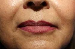 Before Results for Lip Augmentation