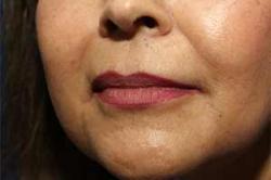 Before Results for Tissue Fillers, Lip Augmentation