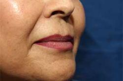 Before Results for Lip Augmentation