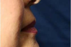 Before Results for Lip Augmentation