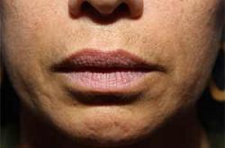 After Results for Lip Augmentation