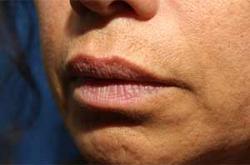 After Results for Tissue Fillers, Lip Augmentation