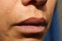 After Results for Lip Augmentation