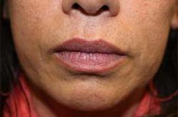 Before Results for Tissue Fillers, Lip Augmentation