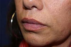 Before Results for Tissue Fillers, Lip Augmentation