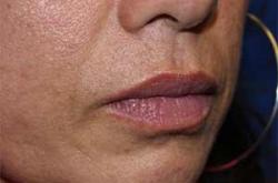 Before Results for Lip Augmentation