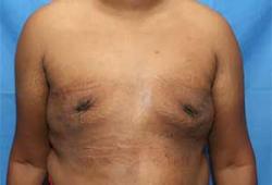 After Results for Gynecomastia