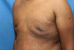 After Results for Gynecomastia