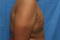 After Results for Gynecomastia